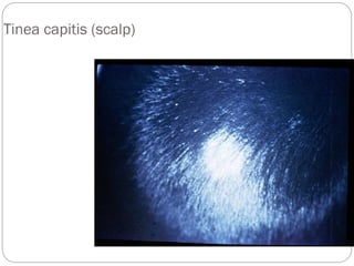 668
Tinea capitis (scalp)
 