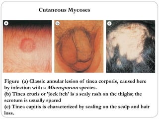 669
Figure (a) Classic annular lesion of tinea corporis, caused here
by infection with a Microsporum species.
(b) Tinea cruris or 'jock itch' is a scaly rash on the thighs; the
scrotum is usually spared
(c) Tinea capitis is characterized by scaling on the scalp and hair
loss.
Cutaneous Mycoses
 