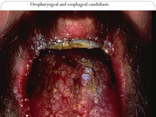 677
Oropharyngeal and esophageal candidiasis
 