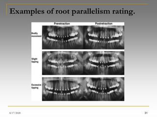 clinical application of microimplants in orthodontics | PPT
