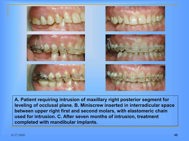 clinical application of microimplants in orthodontics | PPT