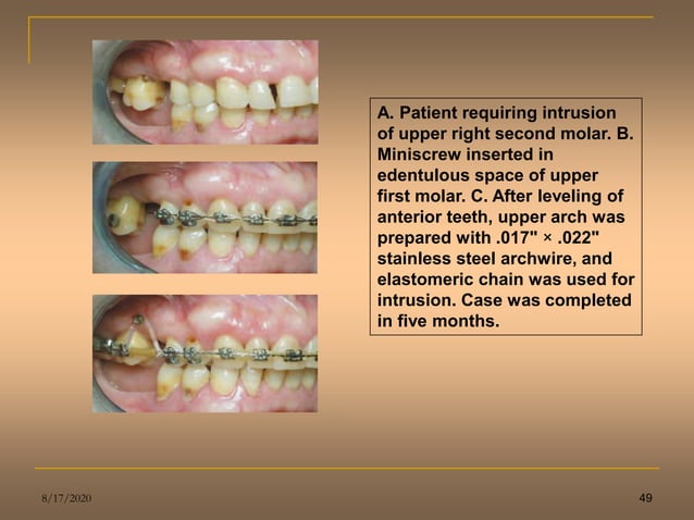 clinical application of microimplants in orthodontics | PPT