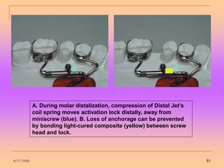 Distalisation Jet clinical application of microimplants in orthodontics | PPT