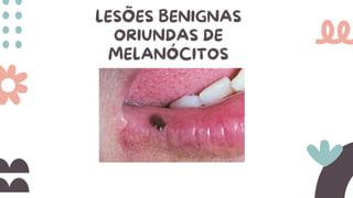 LESÕES BENIGNAS
ORIUNDAS DE
MELANÓCITOS
 