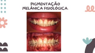 PIGMENTAÇÃO
MELÂNICA FISIOLÓGICA.
 