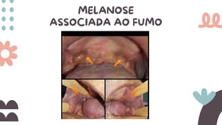 MELANOSE
ASSOCIADA AO FUMO
 