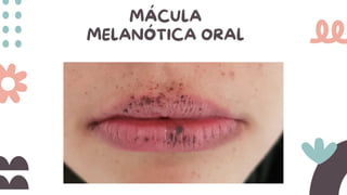 MÁCULA
MELANÓTICA ORAL
 