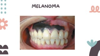 MELANOMA
 