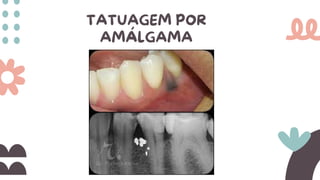 TATUAGEM POR
AMÁLGAMA
 