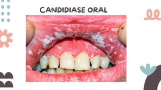 CANDIDIASE ORAL
 