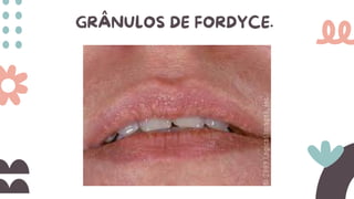 GRÂNULOS DE FORDYCE.
 