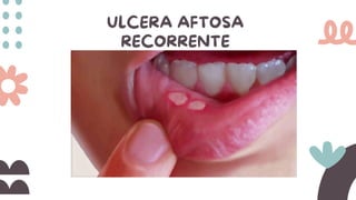 ULCERA AFTOSA
RECORRENTE
 