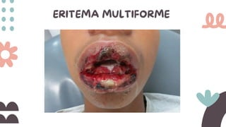 ERITEMA MULTIFORME
 