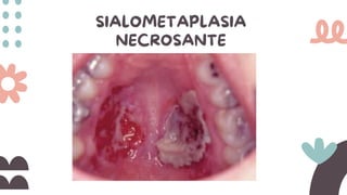 SIALOMETAPLASIA
NECROSANTE
 