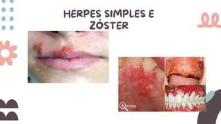 HERPES SIMPLES E
ZÓSTER
 