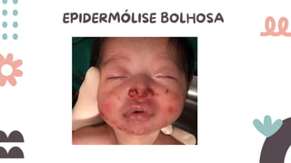 EPIDERMÓLISE BOLHOSA
 