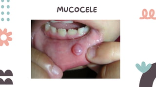 MUCOCELE
 