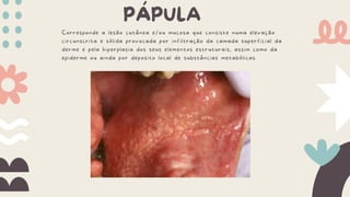 PÁPULA
Corresponde a lesão cutânea e/ou mucosa que consiste numa elevação
circunscrita e sólida provocada por infiltração da camada superficial da
derme e pela hiperplasia dos seus elementos estruturais, assim como da
epiderme ou ainda por deposito local de substâncias metabólicas
 