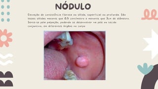 NÓDULO
Elevação de consistência fibrosa ou sólida, superficial ou profunda. São
lesões sólidas maiores que 0,5 centímetro e menores que 3cm de diâmetro.
Sente-se pela palpação, podendo se desenvolver na pele ou tecido
conjuntivo, em diferentes órgãos no corpo
 