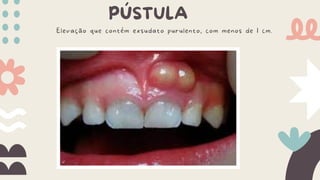 PÚSTULA
Elevação que contém exsudato purulento, com menos de 1 cm.
 