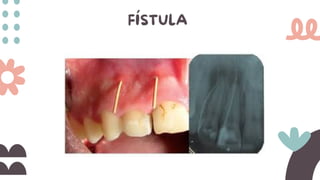 FÍSTULA
 