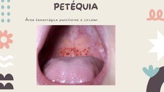 PETÉQUIA
Área hemorrágica puntiforme e circular.
 