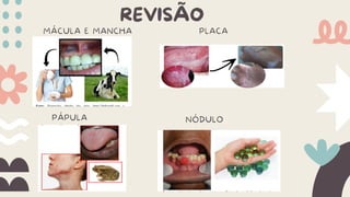 REVISÃO
MÁCULA E MANCHA PLACA
PÁPULA NÓDULO
 