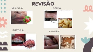 REVISÃO
VESÍCULA BOLHA
PÚSTULA
EROSÃO
 