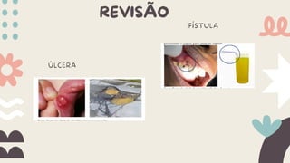 REVISÃO
ÚLCERA
FÍSTULA
 