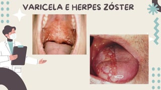 VARICELA E HERPES ZÓSTER
 