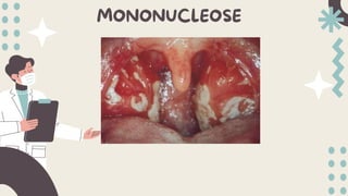 MONONUCLEOSE
 