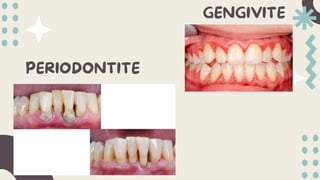 GENGIVITE
PERIODONTITE
 
