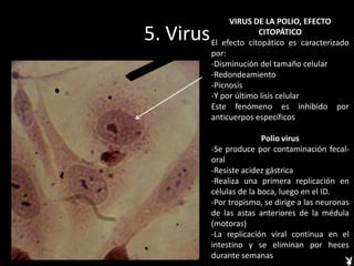 5. Virus
VIRUS DE LA POLIO, EFECTO
CITOPÁTICO
El efecto citopático es caracterizado
por:
-Disminución del tamaño celular
-Redondeamiento
-Picnosis
-Y por último lisis celular
Este fenómeno es inhibido por
anticuerpos específicos
Polio virus
-Se produce por contaminación fecal-
oral
-Resiste acidez gástrica
-Realiza una primera replicación en
células de la boca, luego en el ID.
-Por tropismo, se dirige a las neuronas
de las astas anteriores de la médula
(motoras)
-La replicación viral continua en el
intestino y se eliminan por heces
durante semanas
 