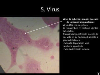 5. Virus
Virus de la herpes simple, cuerpos
de inclusión intranucleares
Virus ADN con envoltura.
Se transcriben y replican dentro
del núcleo.
Todos inducen infección latente de
por vida en su huéspoed, debido a
genes de latencia:
-Evitan la depuración viral
-Inhibe la apoptosis
-Evita la detección inmune
 