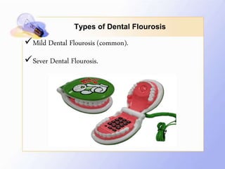 Types of Dental Flourosis
Mild Dental Flourosis (common).
Sever Dental Flourosis.
 