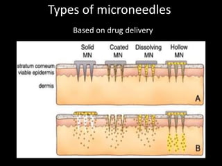 Microneedles in transdermal drug delivery | PPTX