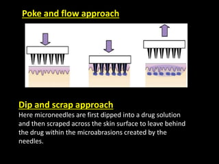 Microneedles in transdermal drug delivery | PPTX