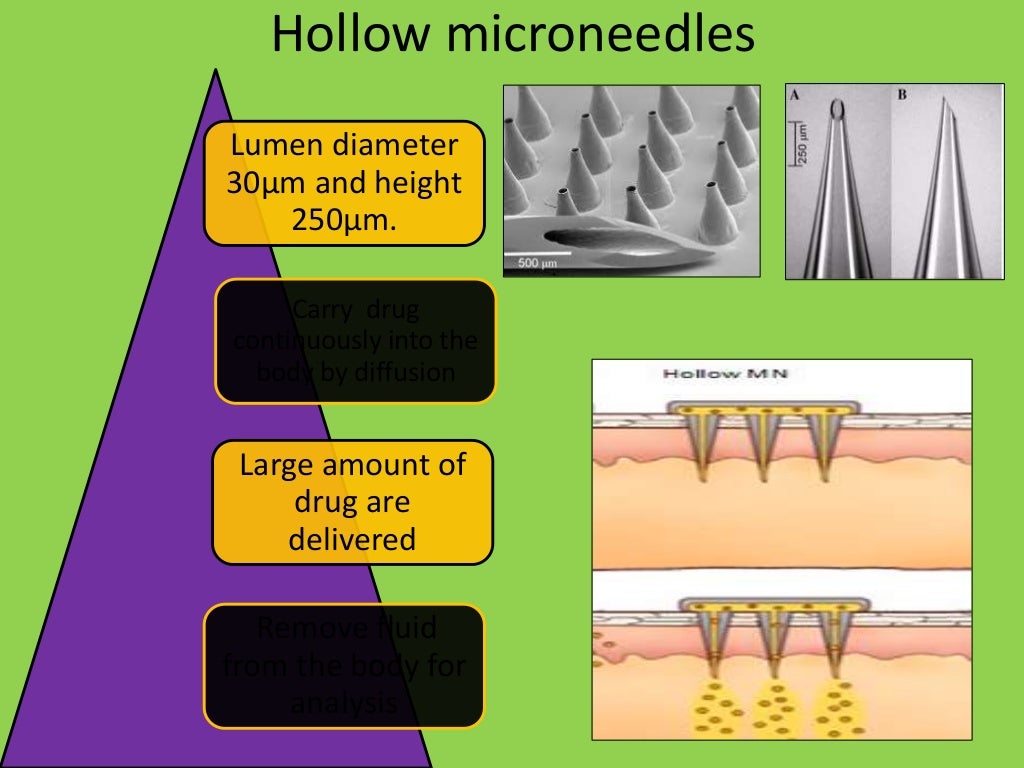 Microneedles in transdermal drug delivery