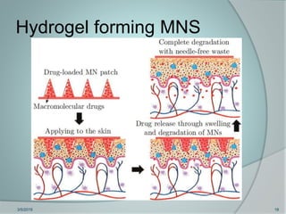 Microneedles in Transdermal Drug Delivery System | PPTX