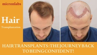 Hair
Transplantation
HAIRTRANSPLANTS:THEJOURNEYBACK
TOBEINGCONFIDENT!
micronlabs
 