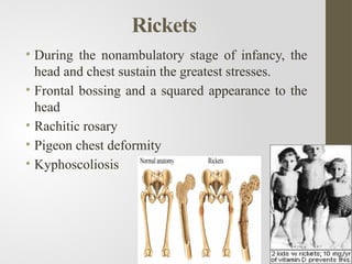 Micronutrient deficinecy disorders .pptx
