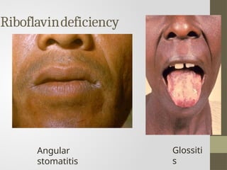 Micronutrient deficinecy disorders .pptx