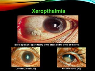 Xeropthalmia
Bitots spots (X1B) are foamy white areas on the white of the eye.
Corneal Xerosis(X2) Keratomalacia (X3)
 