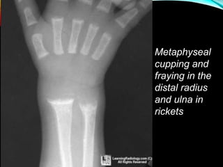 Metaphyseal
cupping and
fraying in the
distal radius
and ulna in
rickets
 