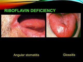 RIBOFLAVIN DEFICIENCY
Angular stomatitis Glossitis
 