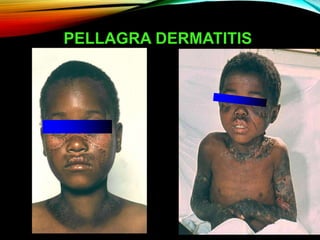 PELLAGRA DERMATITIS
 