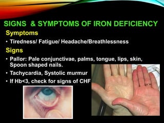 SIGNS & SYMPTOMS OF IRON DEFICIENCY
Symptoms
• Tiredness/ Fatigue/ Headache/Breathlessness
Signs
• Pallor: Pale conjunctivae, palms, tongue, lips, skin,
Spoon shaped nails.
• Tachycardia, Systolic murmur
• If Hb<3, check for signs of CHF
 