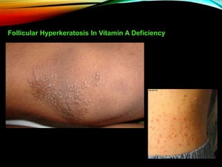 Follicular Hyperkeratosis Vitamin A Deficiency
