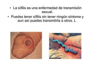 La sífilis es una enfermedad de transmisión sexual. Puedes tener sífilis sin tener ningún síntoma y aun así puedes transmitirla a otros. L  