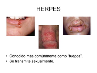 HERPES Conocido mas comúnmente como “fuegos”. Se transmite sexualmente. 